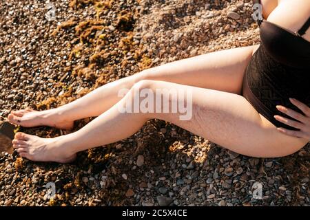 Varianz. Eine Frau sitzt am Strand und zeigt ein Gefäßgewebe an ihrer Hüfte. Nahaufnahme der Beine. Der Blick vom oberen Ausschnitt der Badesachen Szenen. Stockfoto