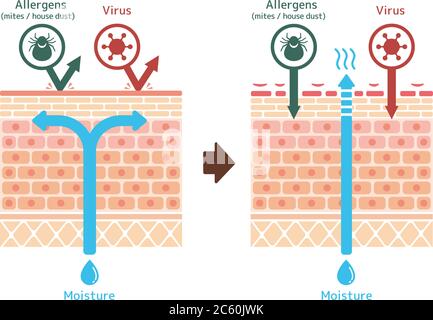 Schnittansicht der atopischen Dermatitis und der normalen Haut / Vergleichende Vektordarstellung Stock Vektor