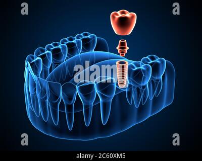 3d-Rendering von Kiefer-Röntgen mit dentaler Implantatplatzierung Stockfoto