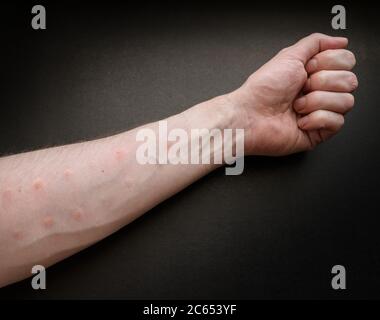 Markierungen von einem Allergietest auf einer Hand. Stockfoto