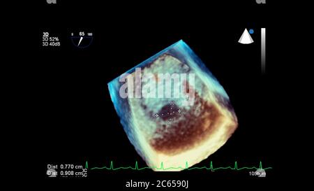 3D-Bild des Herzens während der transösophagealen Ultraschall des Herzens. Stockfoto