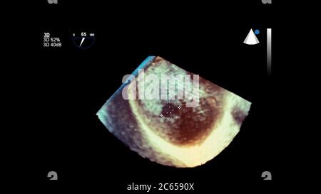 3D-Bild des Herzens während der transösophagealen Ultraschall des Herzens. Stockfoto