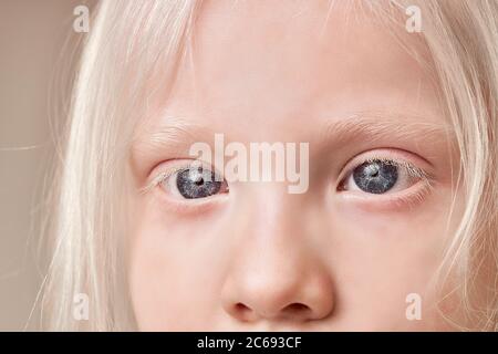 Close-up Foto von schönen blauen Augen von Albino Kind Mädchen suchen Seite. Charming Look, natürliche Schönheit Konzept Stockfoto