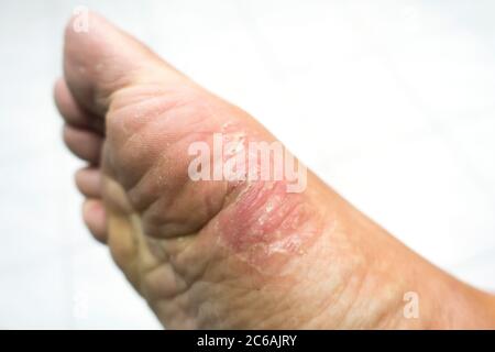 Nahaufnahme einer Fußerkrankung eines Athleten. Es ist eine häufige Hautinfektion der Füße durch Pilz verursacht. Stockfoto