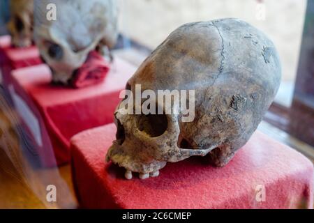 Paracas alten verlängerten menschlichen Schädel mit kranialer Deformation durch kraniale Bindung, Chivay, Peru Stockfoto