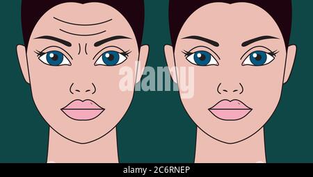 Falten auf der Stirn des Weibeins vor und nach Botulinumtoxinininjektionen. Vektorgrafik Stock Vektor