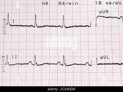 Ekg-Test zeigt, dass die elektrische Aktivität des Herzens Stockfoto