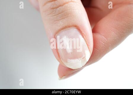 Gebrochener Nagel auf einer weiblichen Hand. Nahaufnahme von gebrochenen Nagel. Stockfoto