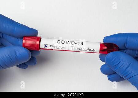 Arzt führt positiven Bluttest auf Coronavirus. Röhrchen für die biologische Analyse mit Etikett Covid-19. Stockfoto