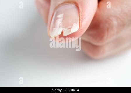 Gebrochener Nagel auf einer weiblichen Hand. Nahaufnahme von gebrochenen Nagel. Stockfoto