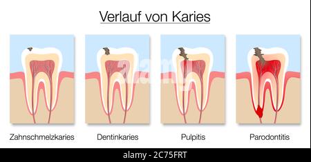 Kariesstadien Infografik, deutsche Kennzeichnung, Entwicklung von Karies mit Zahnschmelz und Dentin Karies, Pulpitis und Parodontitis. Stockfoto