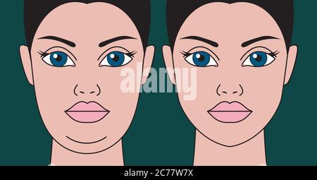 Doppelkinn, Wiederherstellung der Gesichtskonturen mit Hilfe Fettabsaugung, Gewichtsverlust und Bewegung. Verjüngung des weiblichen Gesichts. Stock Vektor