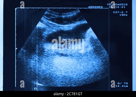 Foto von Ultraschall des Magens in Blauton Stockfoto