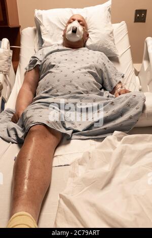 Mann in einem Krankenhausbett schläft mit einem Atemgerät, Bein amputiert, Coronavirus, Krebs, Blutgerinnsel, vertikale Aspekt Stockfoto