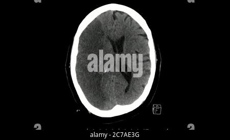 Computertomographie des axialen Schnitts des Gehirns, der einen massiven Infarkt der rechten mittleren Hirnarterie zeigt Stockfoto