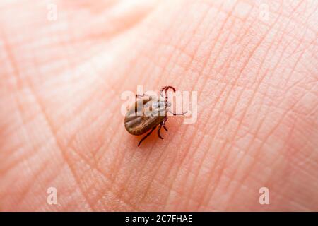 Lyme Krankheit infizierte Zecke Insekt Krabbeln auf der Haut. Enzephalitis Virus oder Lyme-borreliose Krankheit ansteckend Dermacentor Zecke Arachnid Parasit Makro Stockfoto