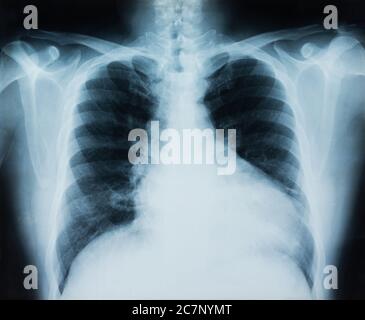 Röntgenbild des Brustkorbs für die medizinische Diagnose. Stockfoto