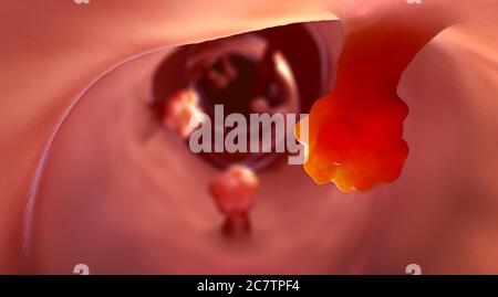 Nahaufnahme von Darmpolypen und erkranktem Darmgewebe, das Krebs verursachen kann - 3d-Illustration Stockfoto