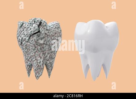 Betroffene gebrochene Molar Zahn und sauber weißen Zahn isoliert auf orangenen Hintergrund. 3d-Illustration Stockfoto