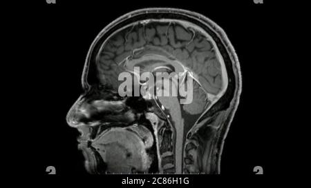 Magnetresonanzbilder des Gehirns (MRT-Gehirn) sagittale Nachkontrast-Sequenz im Cine-Modus, die normale Anatomie zeigt Stockfoto