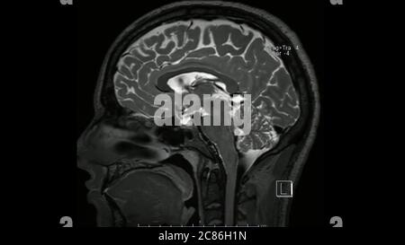 Magnetresonanzbilder des Gehirns (MRT-Gehirn) sagittale T2-gewichtete Sequenz im Cine-Modus, die normale Anatomie zeigt Stockfoto