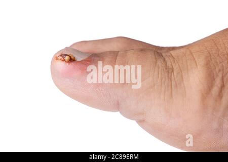 Nahaufnahme von Entzündung und Blut mit schmerzhaften eingewachsenen Zehennagel verbunden Stockfoto