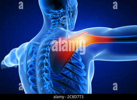 3d-Darstellung medizinisch genaue Darstellung eines Mannes mit einer schmerzhaften Schulter. Stockfoto