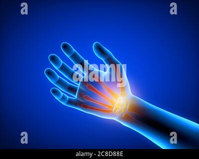 3d-Darstellung medizinisch akkurate Darstellung eines Mannes mit einer schmerzhaften Hand. Stockfoto