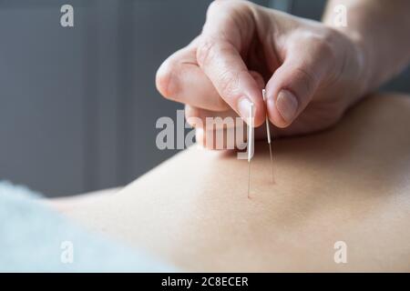 Nahaufnahme Akupunkturist Anwendung Akupunkturnadeln auf den Rücken der Frau Stockfoto