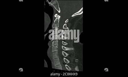 Computertomographie der Halswirbelsäule (CT CS) sagittal im Cine-Modus Stockfoto