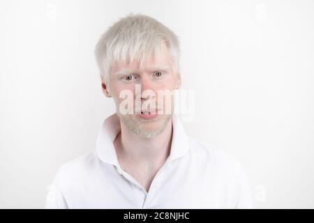 Albinismus Albino Mann im Studio gekleidet T-Shirt isoliert auf weißem Hintergrund. Abnorme Abweichungen. Ungewöhnliches Aussehen. Hautabnormität Stockfoto