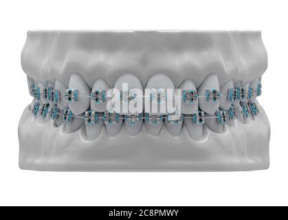 Menschliche Kiefer mit gesunden Zähnen und klassischen Metallspangen, Vorderansicht, isoliert, 3d-Render Stockfoto