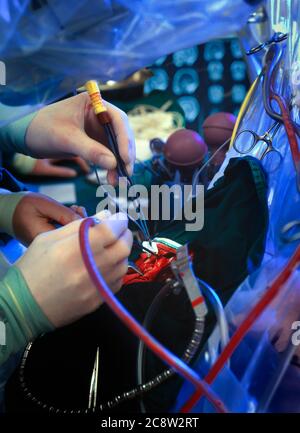 Elektrochirurgische Hirnchirurgie Stockfoto