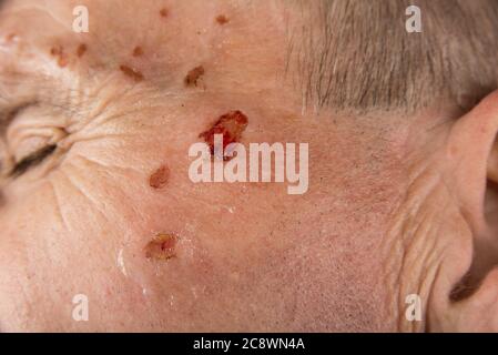 Wunde vom Laser auf dem Gesicht vom Dermatologen Stockfoto