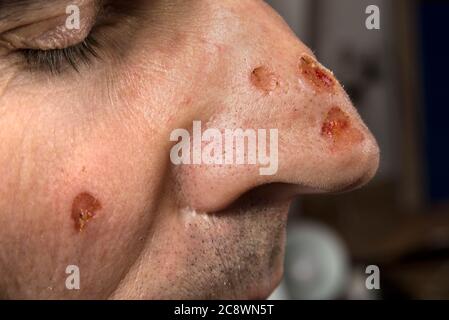 Wunde vom Laser auf dem Gesicht vom Dermatologen Stockfoto