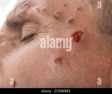 Wunde vom Laser auf dem Gesicht vom Dermatologen Stockfoto