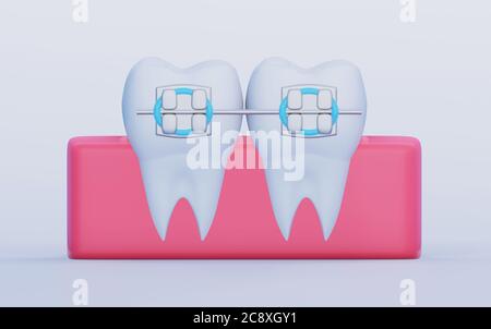 Zwei Zähne mit Metallspangen, Molaren im Zahnfleisch, Vorderansicht. Symbole für Pflege, Kieferorthopädie und Zahnmedizin, 3D-Rendering Stockfoto