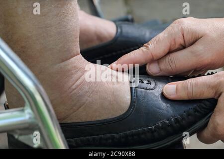 Ältere Frau geschwollene Füße drücken Sie die Taste Test auf Rollstuhl Stockfoto