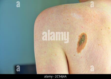 Haarmüll. Nahaufnahme des gefährlichen braunen Nevus auf der menschlichen Haut - Melanom Stockfoto