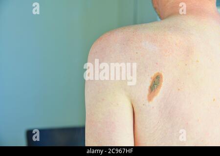 Pigmentierter Nevus. Großes flaches gutartiges braunes Muttermal auf dem Rücken des Mannes. Nahaufnahme des gefährlichen braunen Nevus auf der menschlichen Haut - Melanom Stockfoto