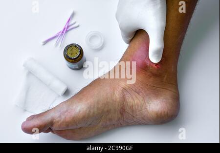 Abszesse bilden sich nach Bakterien. Der Arzt reinigt eitrige Wunde am Fuß des Patienten. Stockfoto