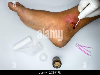 Arzt in medizinischen Handschuhen, die Medizin auf infizierte Wunde am Fuß des Patienten anwenden. Wundverband. Stockfoto