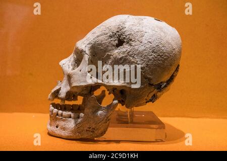 Ein Schädel aus den Ruinen von Monte Alban mit Schädeldeformation und Trepanationsoperation. Monte Alban Site Museum, Oaxaca, Mexiko. EIN UNESCO WELT H Stockfoto