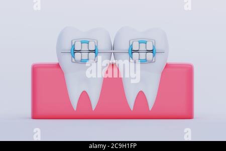 Zwei Zähne mit Metallspangen im Zahnfleisch. Symbole für Pflege, Kieferorthopädie und Zahnmedizin, 3D-Rendering Stockfoto