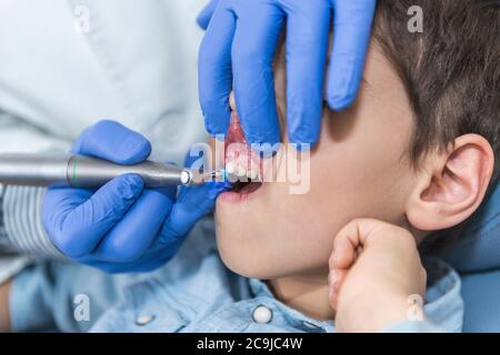 Zahnarzt Entfernen Zahnstein aus einem Jungen Zähne. Stockfoto