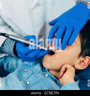 Zahnarzt Entfernen Zahnstein aus einem Jungen Zähne. Stockfoto