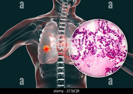 Lungenkrebs, Computerdarstellung und leichte Mikrograph. Leichte Mikrographik mit Adenokarzinom der Lunge. Stockfoto