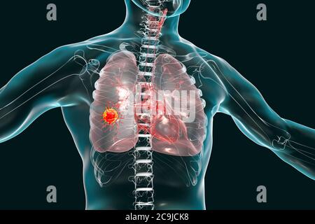 Lungenkrebs, Computerdarstellung mit bösartigem Tumor in der Lunge. Stockfoto