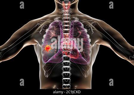 Lungenkrebs, Computerdarstellung mit bösartigem Tumor in der Lunge. Stockfoto