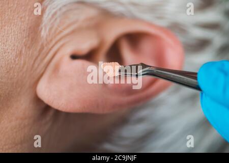 Aurikulotherapie oder aurikuläre Behandlung am menschlichen Ohr, Nahaufnahme. Therapeuten Hand Anwendung Akupunktur Ohrkern Aufkleber mit Pinzette. Stockfoto